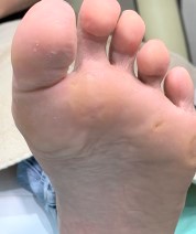 足の人差し指の下のタコ（施術後）