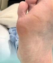 足の小指の下の角質（施術後）